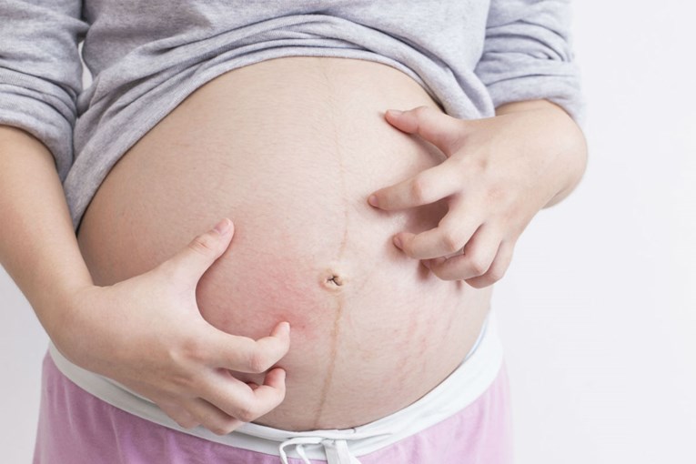 Pojava tamne linije ispod pupka u trudnoći je sasvim uobičajena